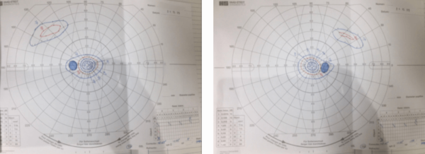 網膜色素変性症