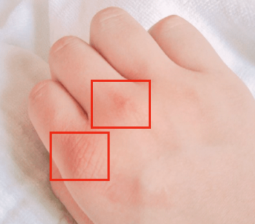 もえあず,吐きだこ