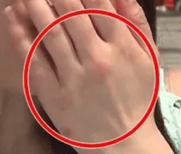 もえあず,吐きだこ